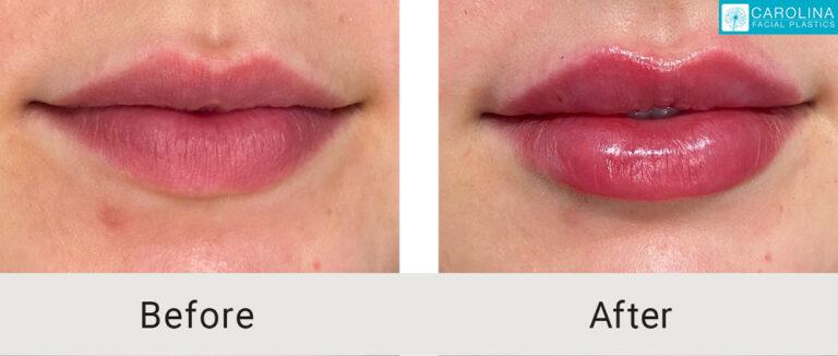 Carolina Facial Plastics lip filler result — Charlotte, NC