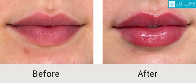 Lip Filler result at Carolina Facial Plastics in Charlotte, NC