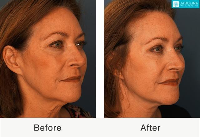 Deep Plane Facelift result at Carolina Facial Plastics in Charlotte, NC
