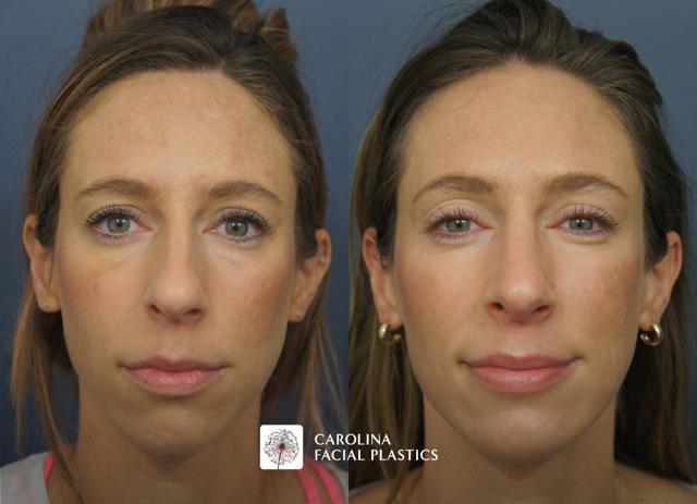 Rhinoplasty result at Carolina Facial Plastics in Charlotte, NC