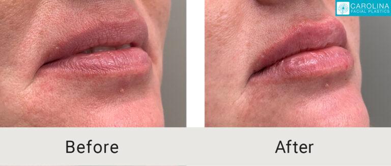 Carolina Facial Plastics lip filler result — Charlotte, NC