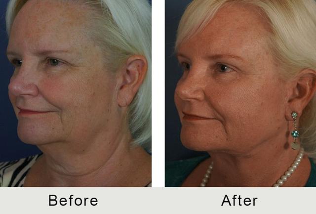 Deep Plane Facelift result at Carolina Facial Plastics in Charlotte, NC