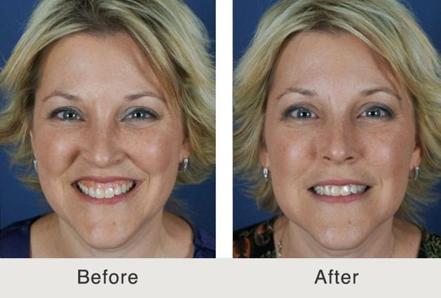 Botox result at Carolina Facial Plastics in Charlotte, NC