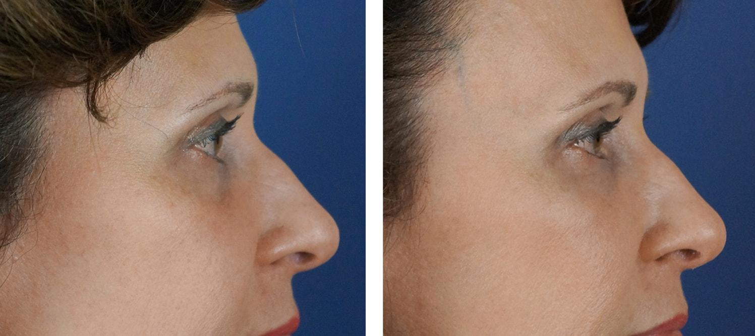 Carolina Facial Plastics under-eye filler result — Charlotte, NC