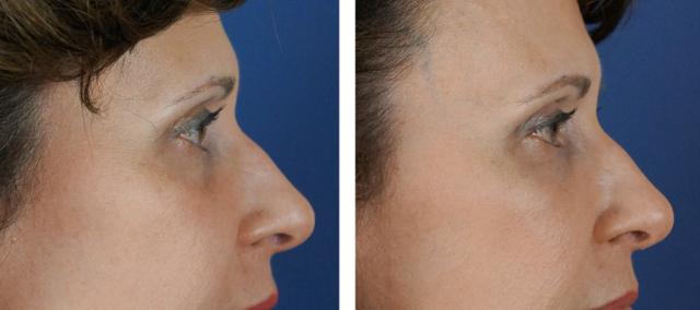 Dermal Fillers result at Carolina Facial Plastics in Charlotte, NC
