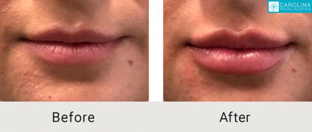 Lip Filler result at Carolina Facial Plastics in Charlotte, NC