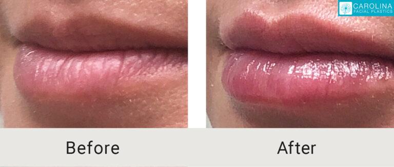 Carolina Facial Plastics lip filler result — Charlotte, NC