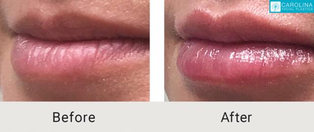 Lip Filler result at Carolina Facial Plastics in Charlotte, NC
