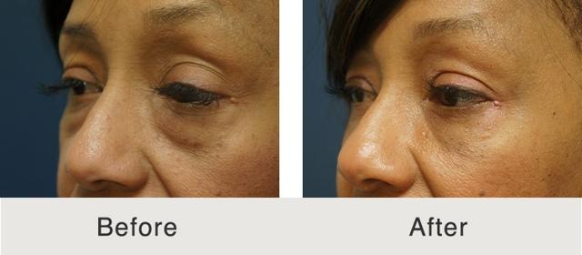 Blepharoplasty result at Carolina Facial Plastics in Charlotte, NC