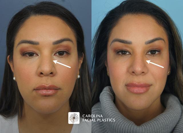 Rhinoplasty result at Carolina Facial Plastics in Charlotte, NC