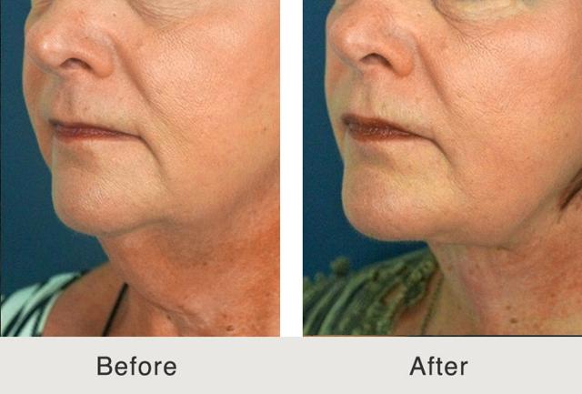 Neck Lift result at Carolina Facial Plastics in Charlotte, NC