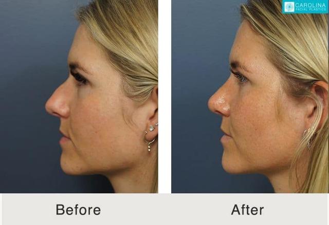 Functional Rhinoplasty result at Carolina Facial Plastics in Charlotte, NC