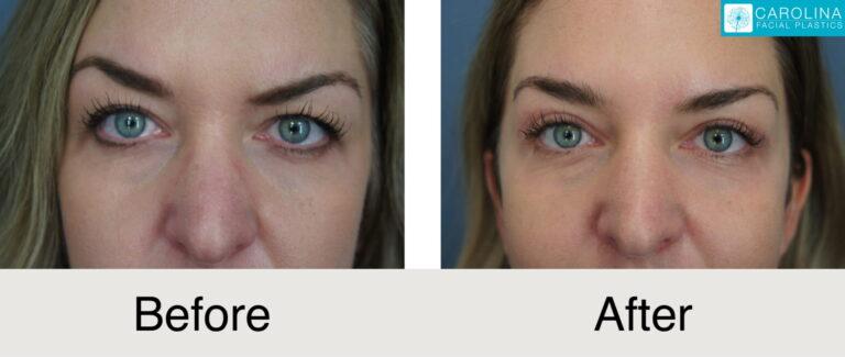 Carolina Facial Plastics blepharoplasty result — Charlotte, NC