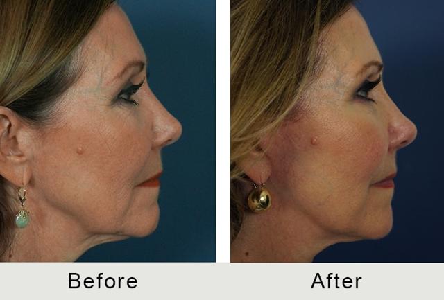 Fat Transfer result at Carolina Facial Plastics in Charlotte, NC
