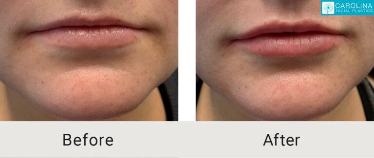 Carolina Facial Plastics lip filler result — Charlotte, NC