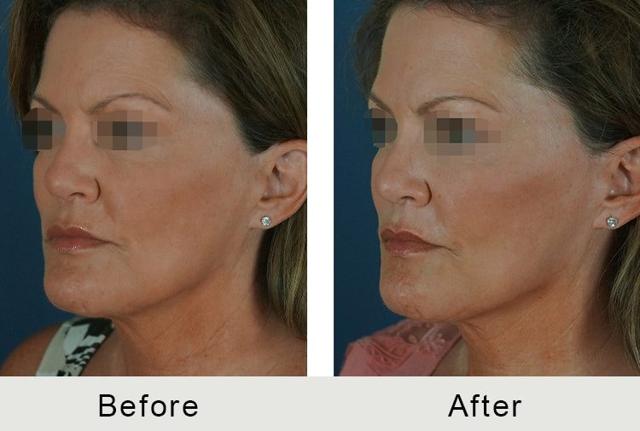 Deep Plane Facelift result at Carolina Facial Plastics in Charlotte, NC