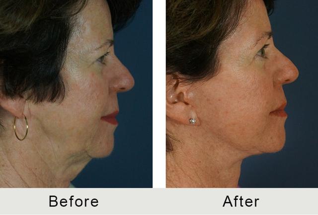 Deep Plane Facelift result at Carolina Facial Plastics in Charlotte, NC