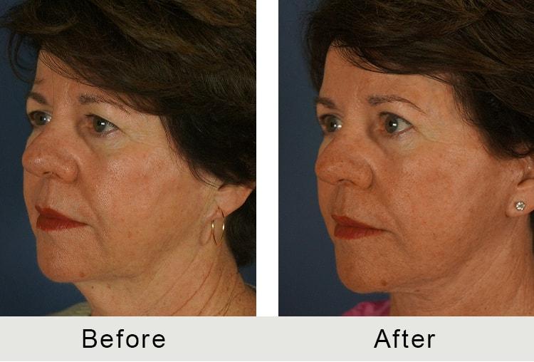 Carolina Facial Plastics neck lift result — Charlotte, NC