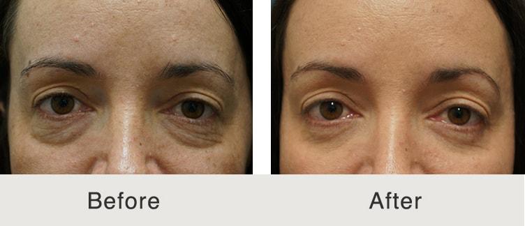 Carolina Facial Plastics eyelid lift result — Charlotte, NC