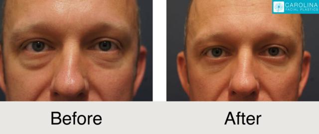 Blepharoplasty result at Carolina Facial Plastics in Charlotte, NC