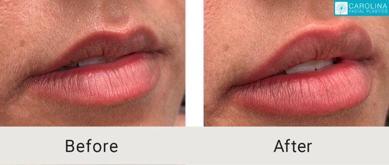 Carolina Facial Plastics lip filler result — Charlotte, NC