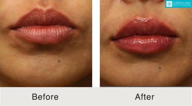 Lip Filler result at Carolina Facial Plastics in Charlotte, NC
