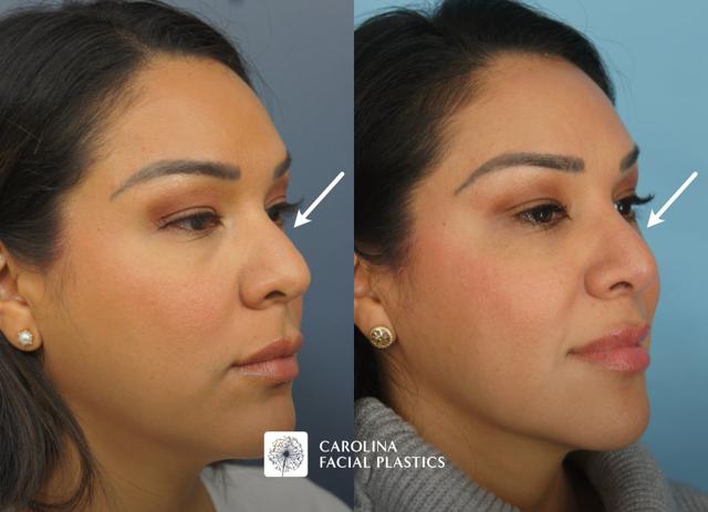 Rhinoplasty result at Carolina Facial Plastics in Charlotte, NC