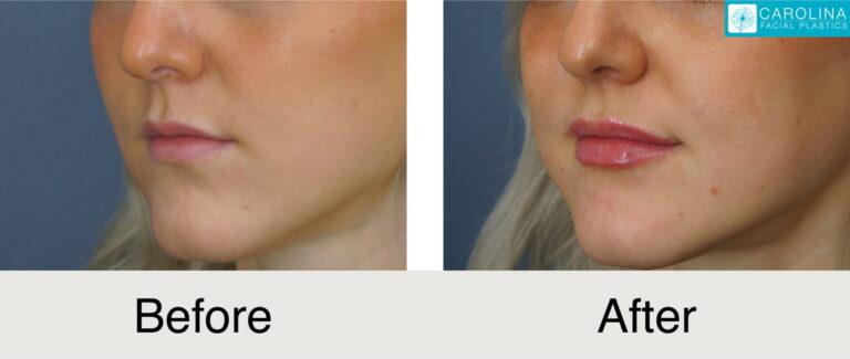 Carolina Facial Plastics lip filler result — Charlotte, NC