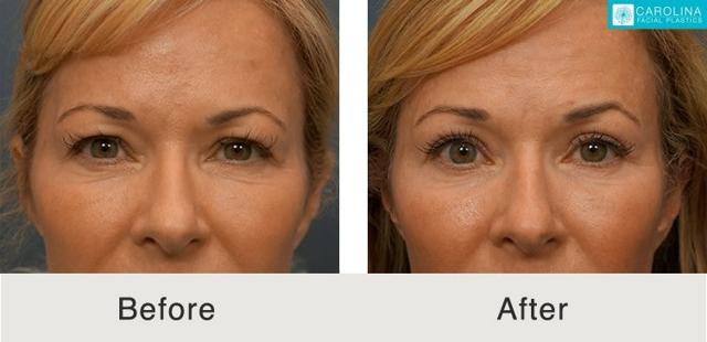 Brow Lift result at Carolina Facial Plastics in Charlotte, NC