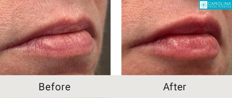 Carolina Facial Plastics lip filler result — Charlotte, NC