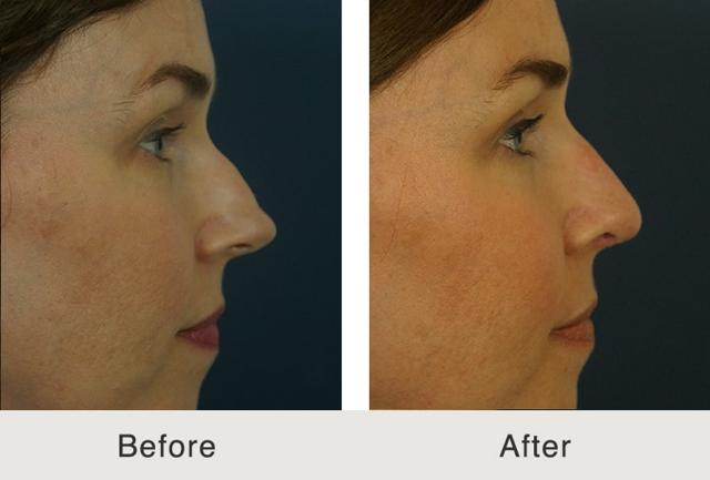 Functional Rhinoplasty result at Carolina Facial Plastics in Charlotte, NC