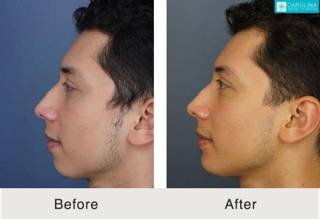 Functional Rhinoplasty result at Carolina Facial Plastics in Charlotte, NC