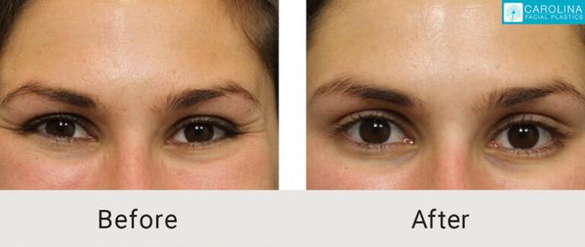 Botox result at Carolina Facial Plastics in Charlotte, NC