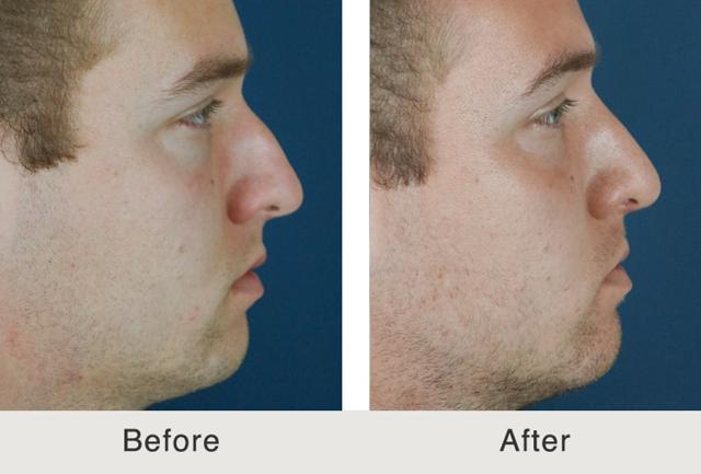 Functional Rhinoplasty result at Carolina Facial Plastics in Charlotte, NC