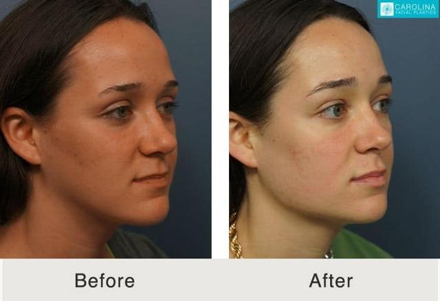 Functional Rhinoplasty result at Carolina Facial Plastics in Charlotte, NC