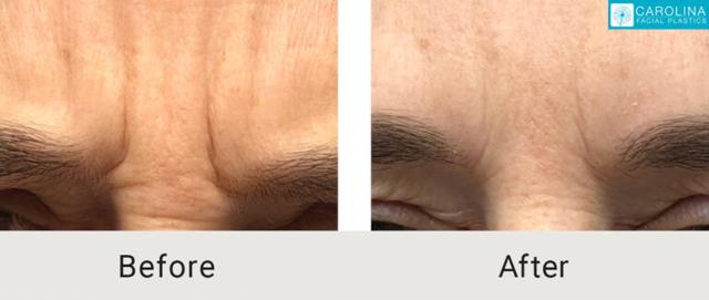 Botox result at Carolina Facial Plastics in Charlotte, NC