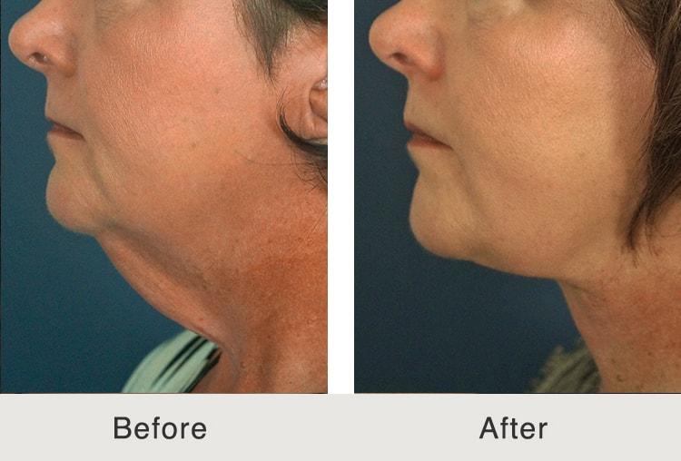 Carolina Facial Plastics neck lift result — Charlotte, NC
