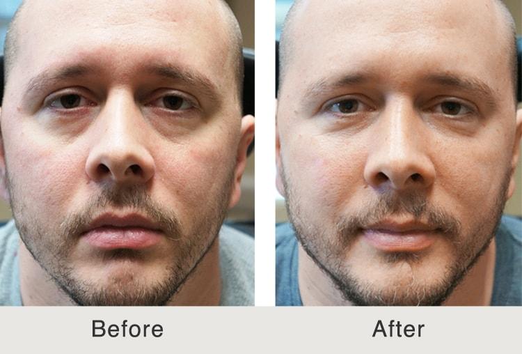 Carolina Facial Plastics under-eye filler result — Charlotte, NC