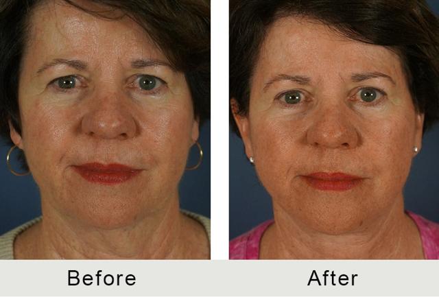 Brow Lift result at Carolina Facial Plastics in Charlotte, NC