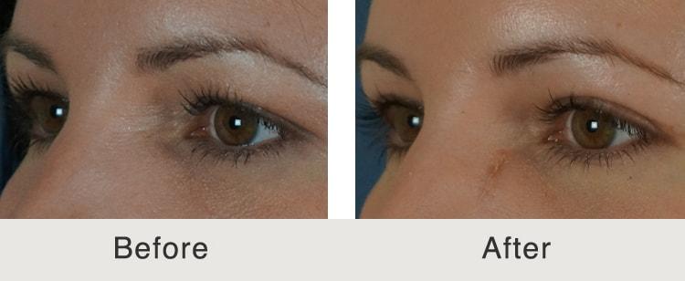 Carolina Facial Plastics under-eye filler result — Charlotte, NC