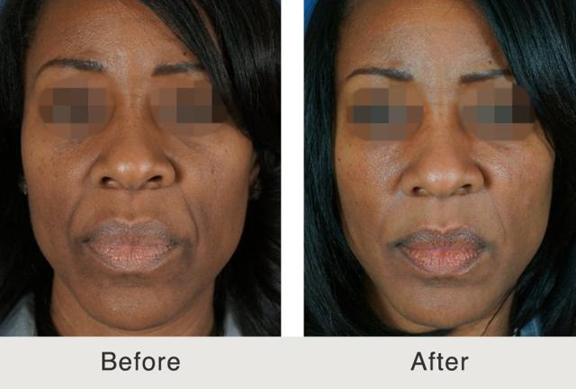 Dermal Fillers result at Carolina Facial Plastics in Charlotte, NC