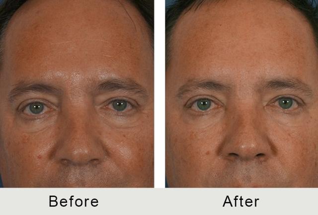Botox result at Carolina Facial Plastics in Charlotte, NC