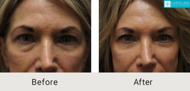 Blepharoplasty result at Carolina Facial Plastics in Charlotte, NC