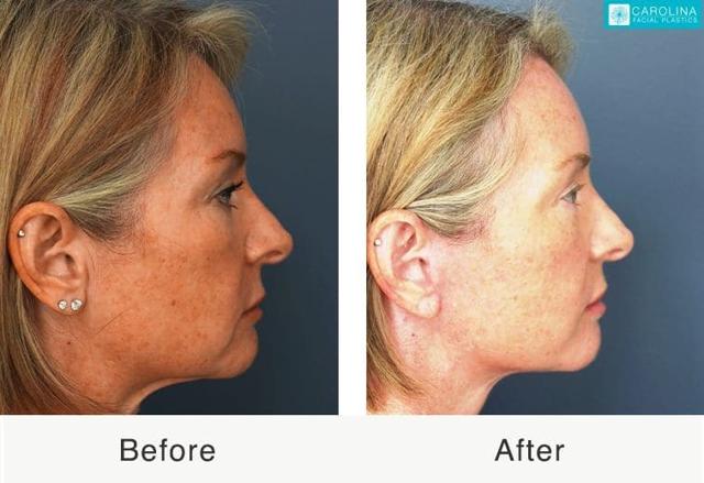 Laser Skin Resurfacing result at Carolina Facial Plastics in Charlotte, NC