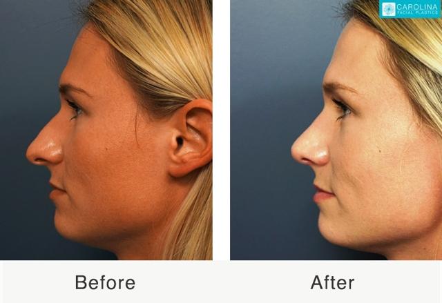 Functional Rhinoplasty result at Carolina Facial Plastics in Charlotte, NC