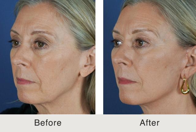 Deep Plane Facelift result at Carolina Facial Plastics in Charlotte, NC