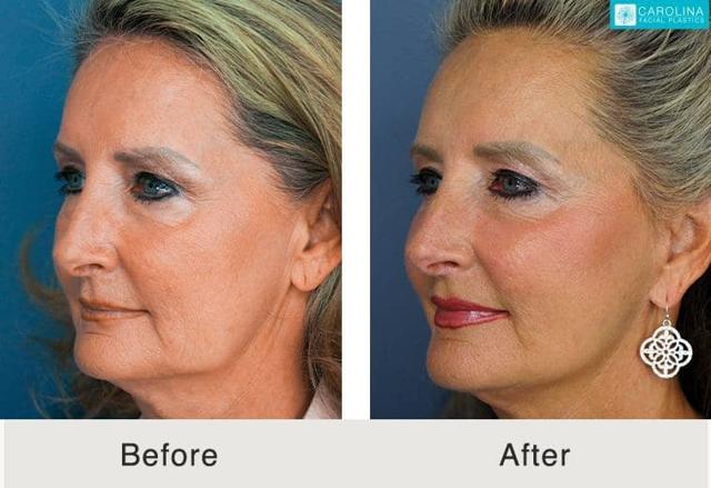 Laser Skin Resurfacing result at Carolina Facial Plastics in Charlotte, NC