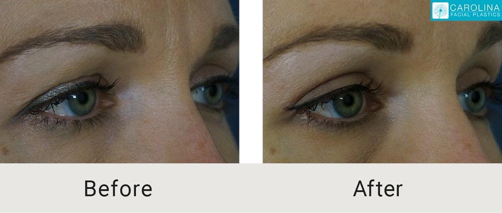 Carolina Facial Plastics eyelid lift result — Charlotte, NC
