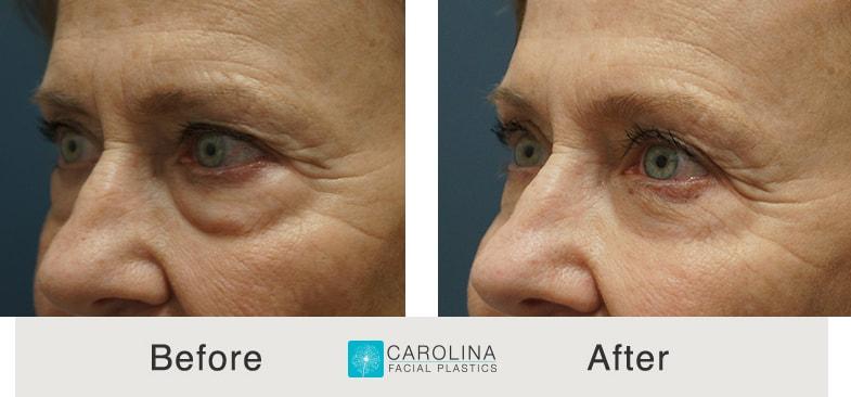 Carolina Facial Plastics eyelid lift result — Charlotte, NC