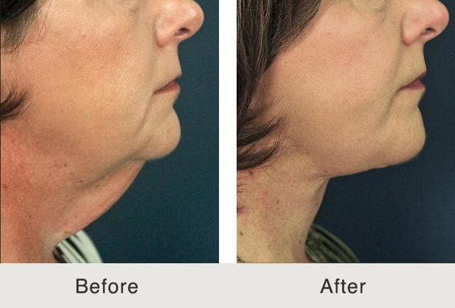Neck Lift result at Carolina Facial Plastics in Charlotte, NC